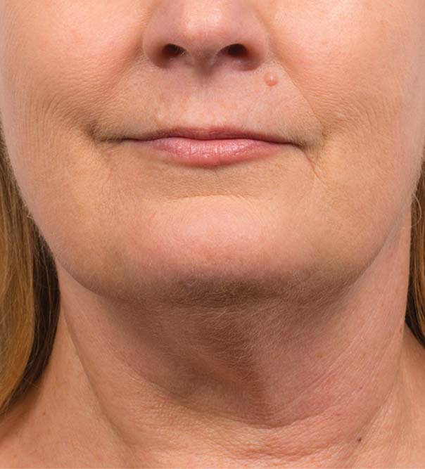 A lady's double chin reduced by the use of CoolMini