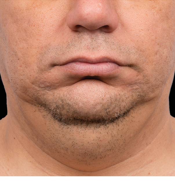 A man's chin and neck before treatment