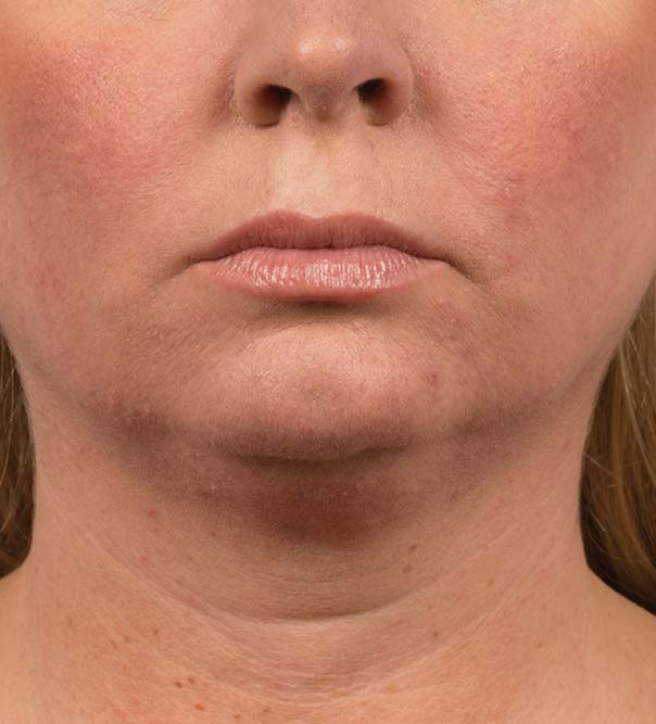 A lady's chin and neck before CoolMini treatment
