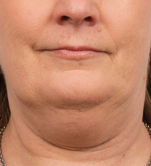 A lady's double chin before CoolMini treatment
