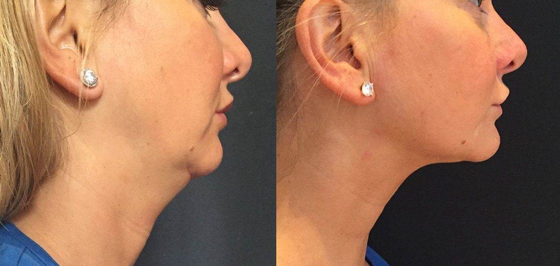 coolmini double chin before and after