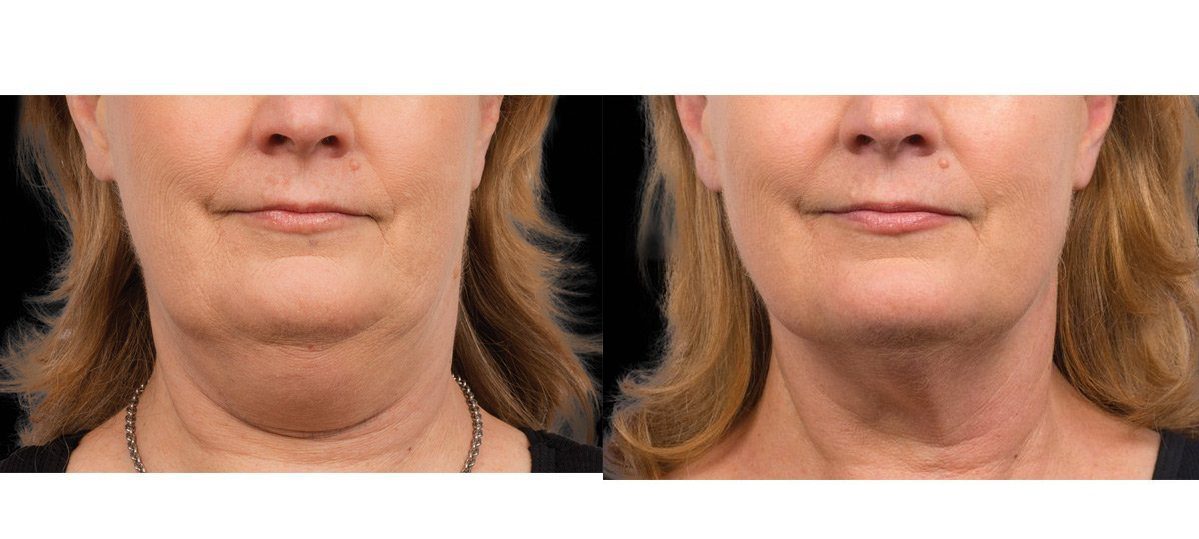 coolmini double chin before and after