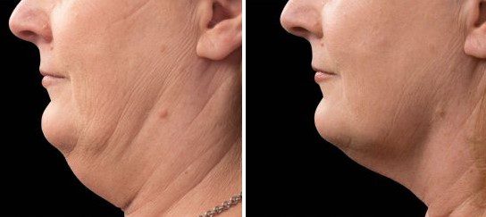 coolmini double chin before and after