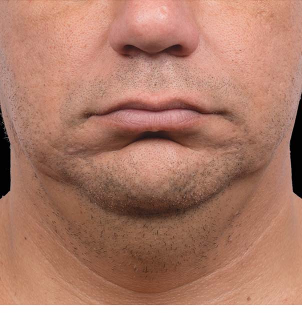 CoolSculpting double chin men after