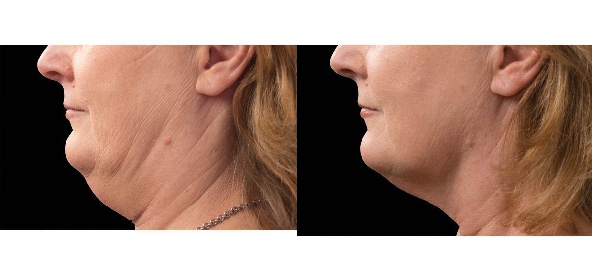 coolmini fat freezing double chin before and after _AJ_Burns_MD