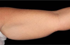 coolsculpting London arm fat removal before