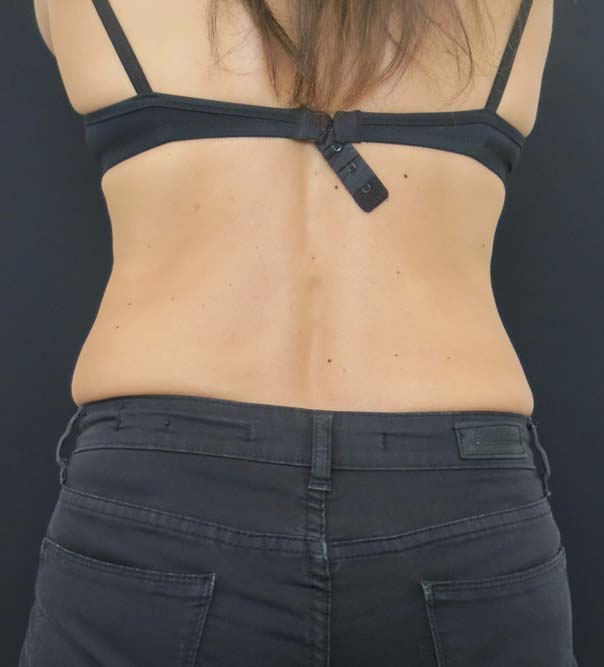 A lady's upper body after fat freezing of the 'muffin top'