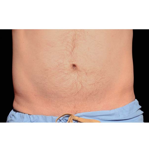 A man's flat stomach following fat freezing to the abdomen