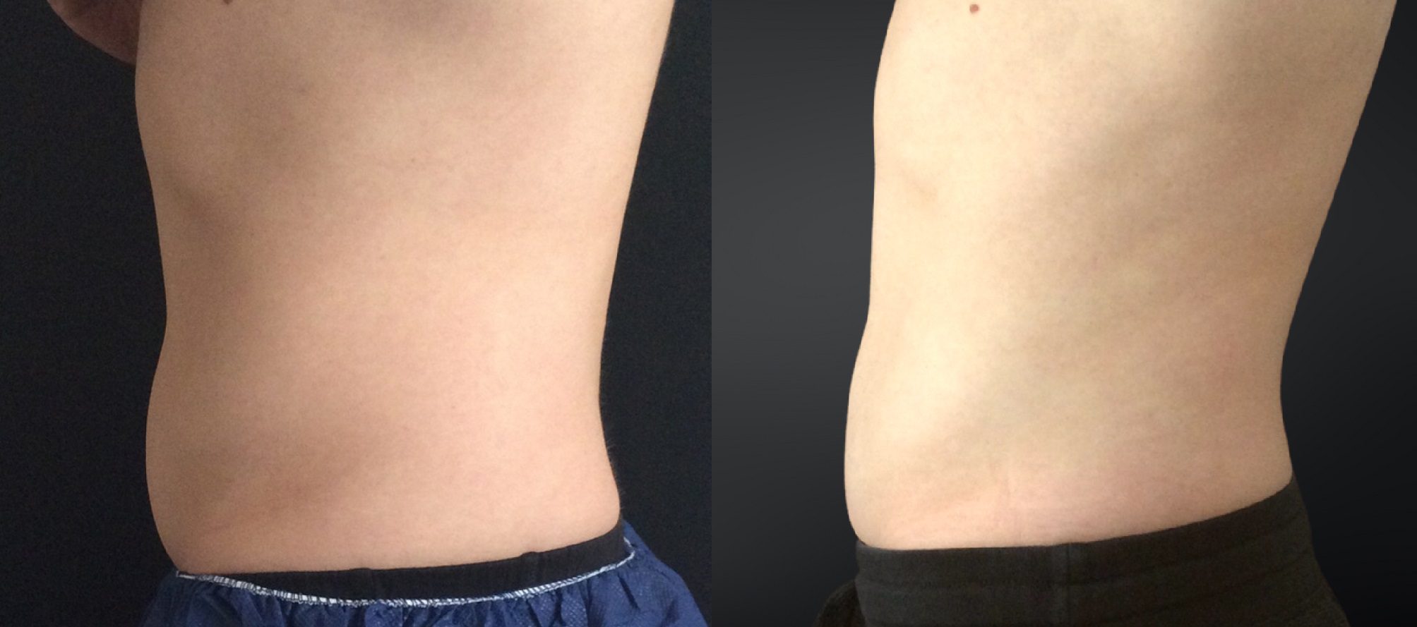 CoolSculpting Fat Freezing near me, London, Buckinghamshire