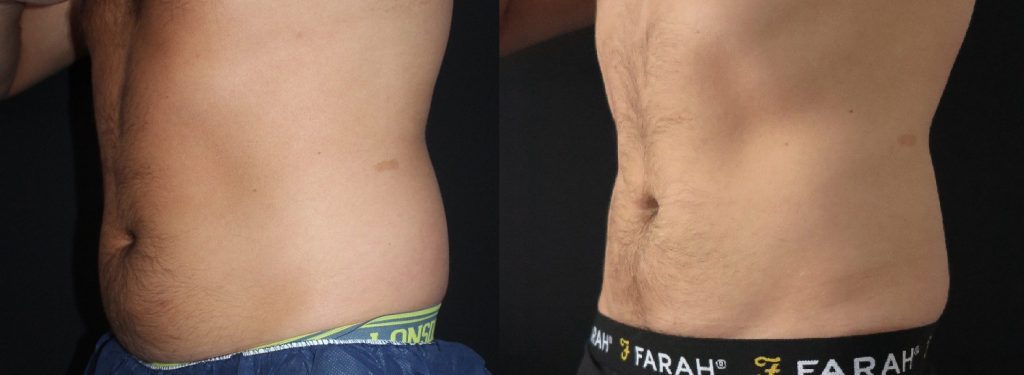 coolsculpting abdomen before and after, coolsculpting belly fat results