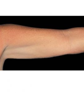 coolsculpting arms after