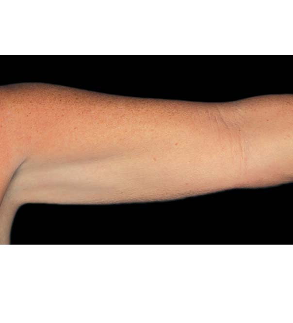 Lose Arm Fat with CoolSculpting London & Bucks Non surgical Arm Fat Removal The Cosmetic