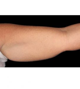 coolsculpting arms before