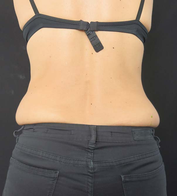 A lady with 'muffin top' before CoolSculpting