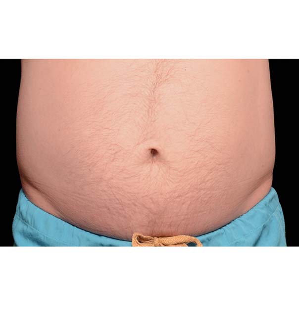 A man's stomach before fat freezing treatment