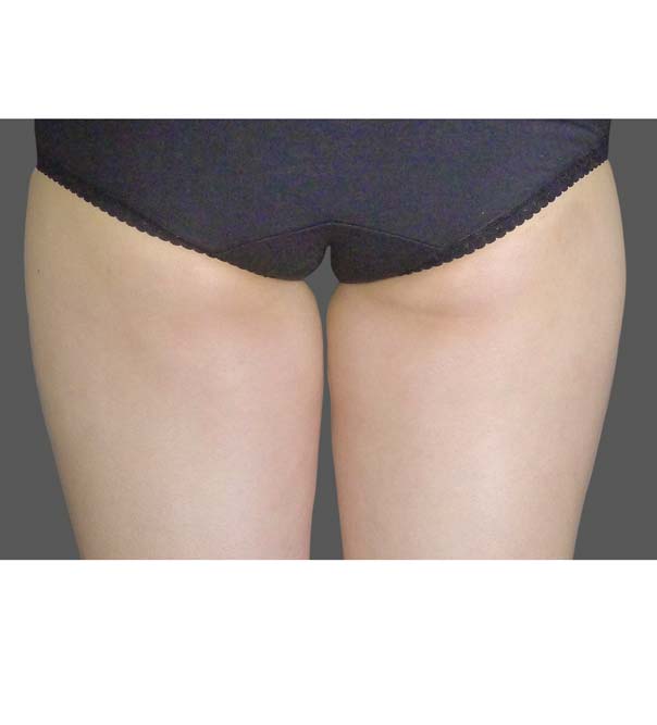 coolsculpting-before-thighs