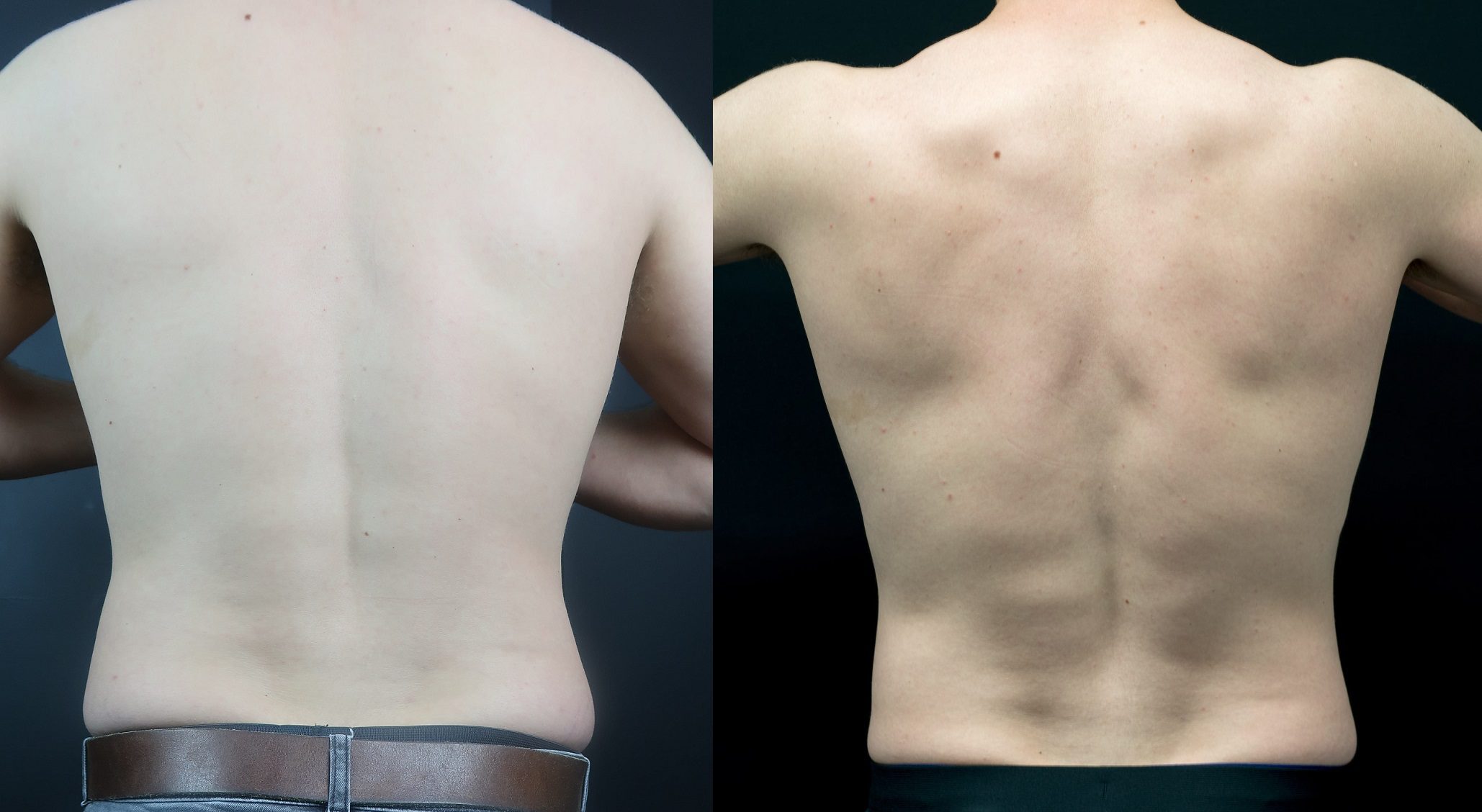 coolsculpting back fat before and after