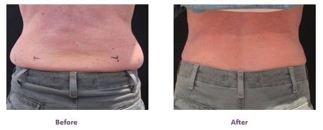 CoolSculpting love handles before and after Coolsculpting before after results