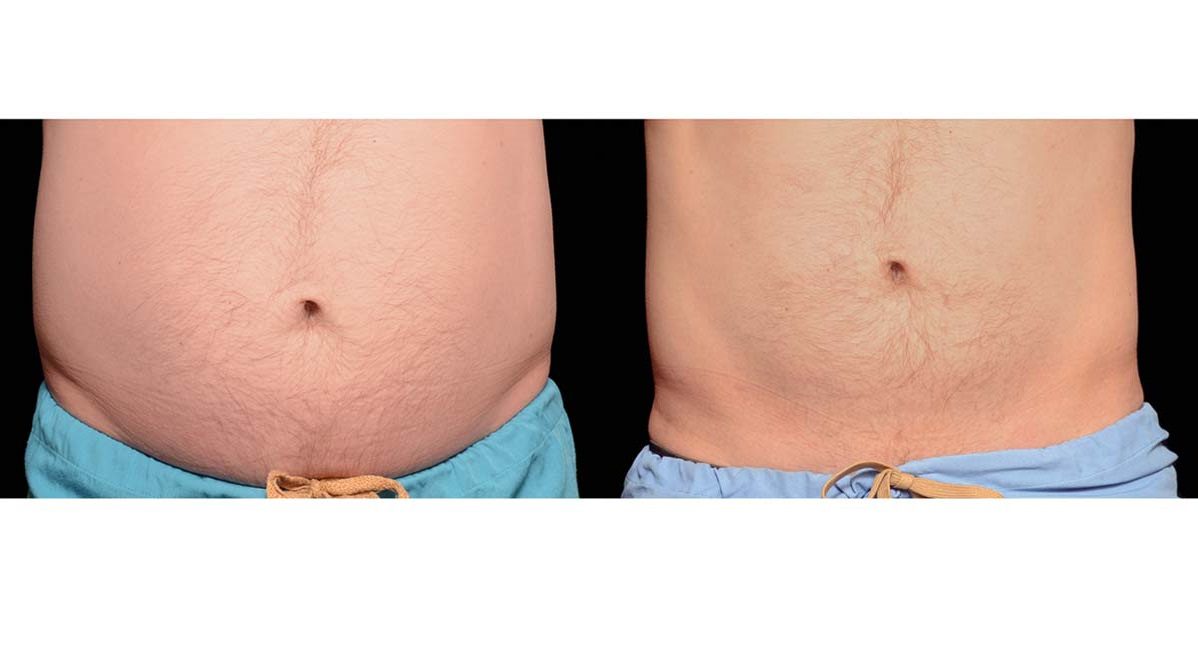 coolsculpting before after stubborn belly fat