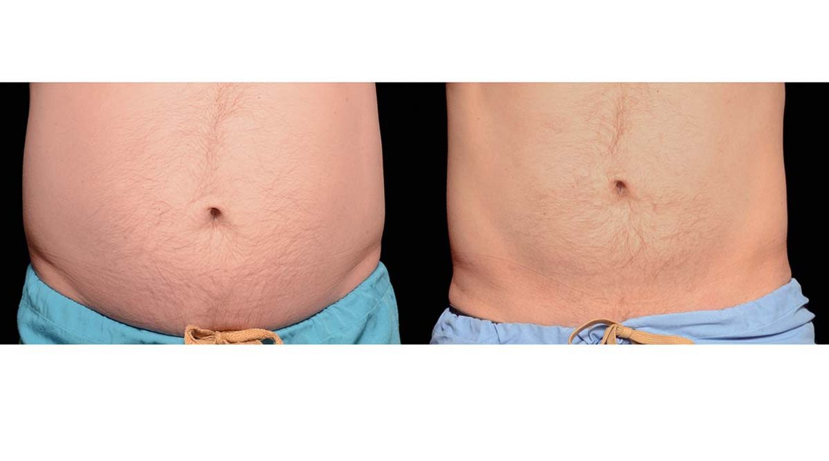 coolsculpting before after stubborn belly fat