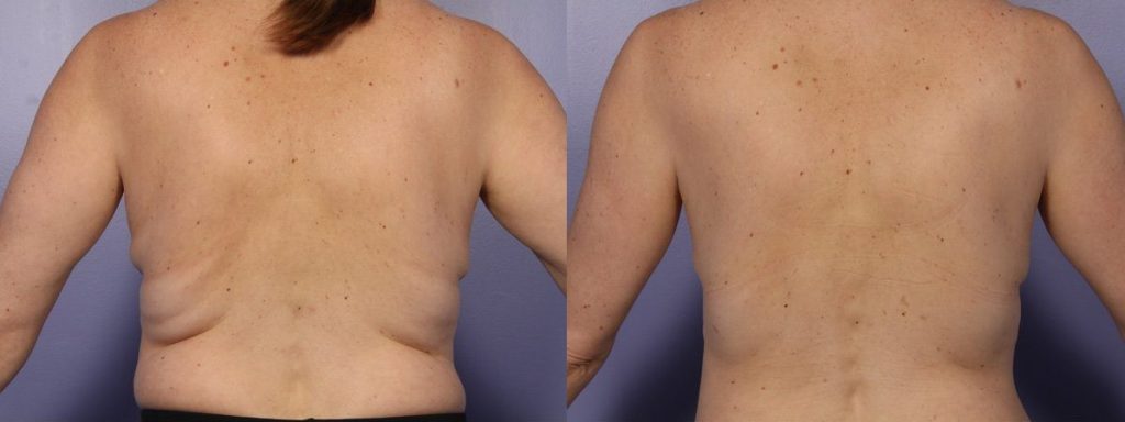 coolsculpting before and after back fat, fat freezing back fat before and after