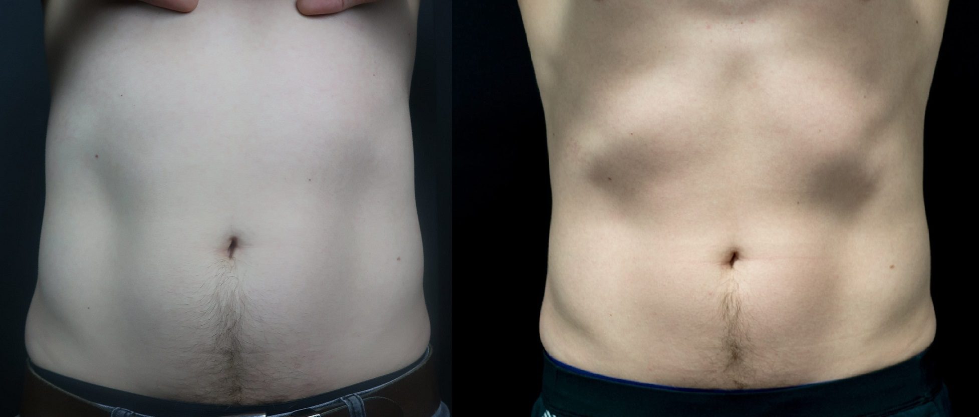 coolsculpting before and after belly fat