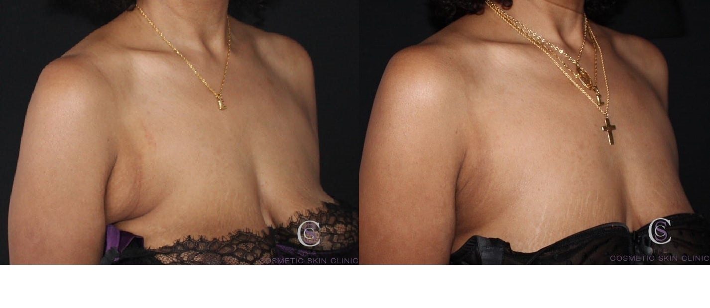 coolsculpting before and after bra fat