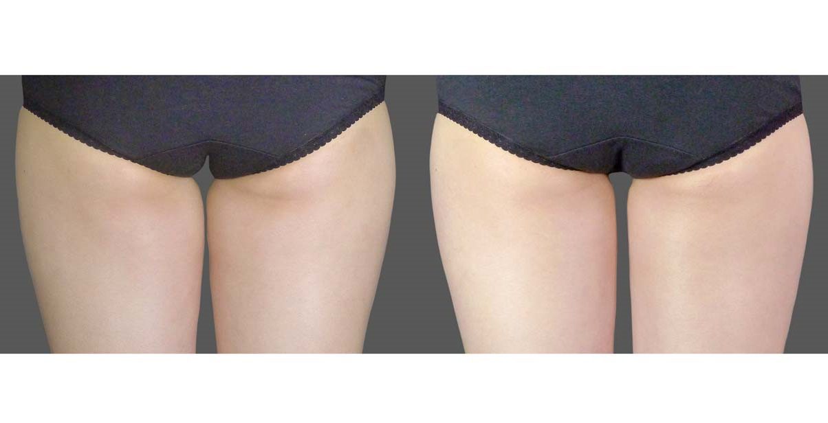 coolsculpting before and after inner thigh fat