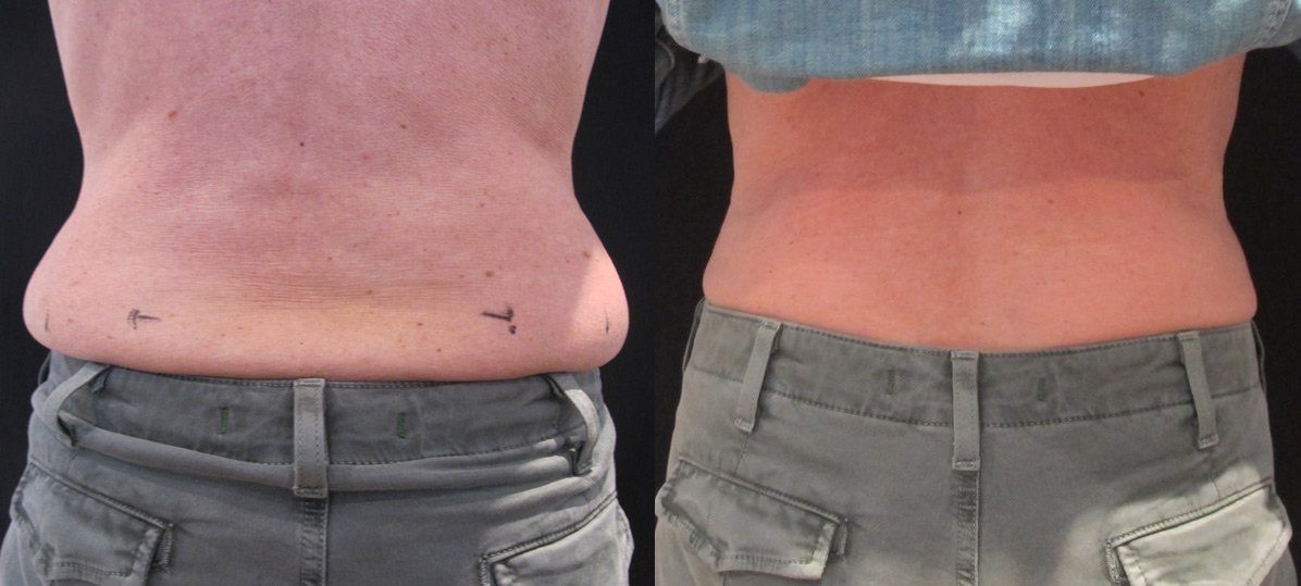 coolsculpting before and after muffin top flanks