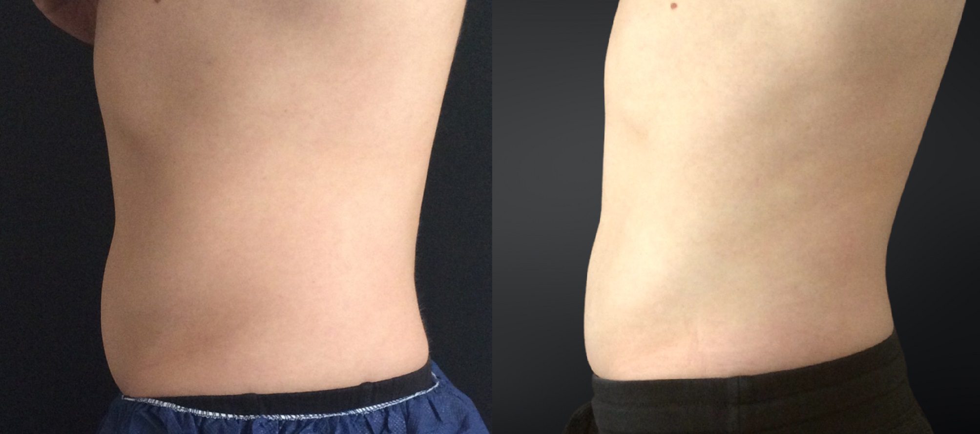 coolsculpting before and after tummy