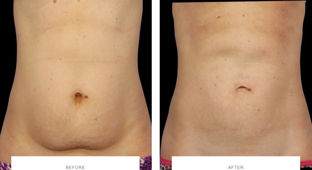 coolsculpting belly fat before and after