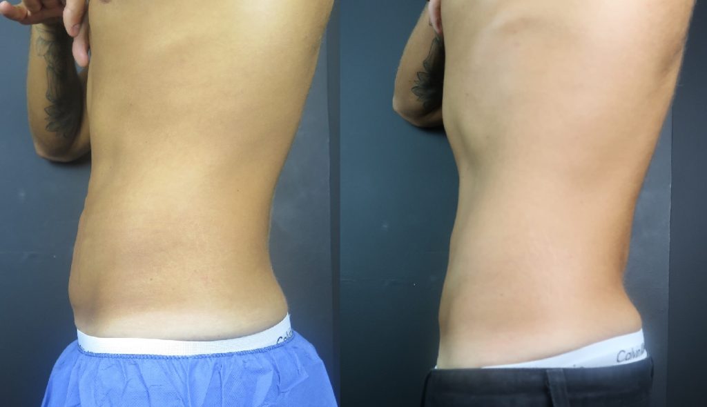 coolsculpting belly fat before and after, fat freezing belly fat before and after