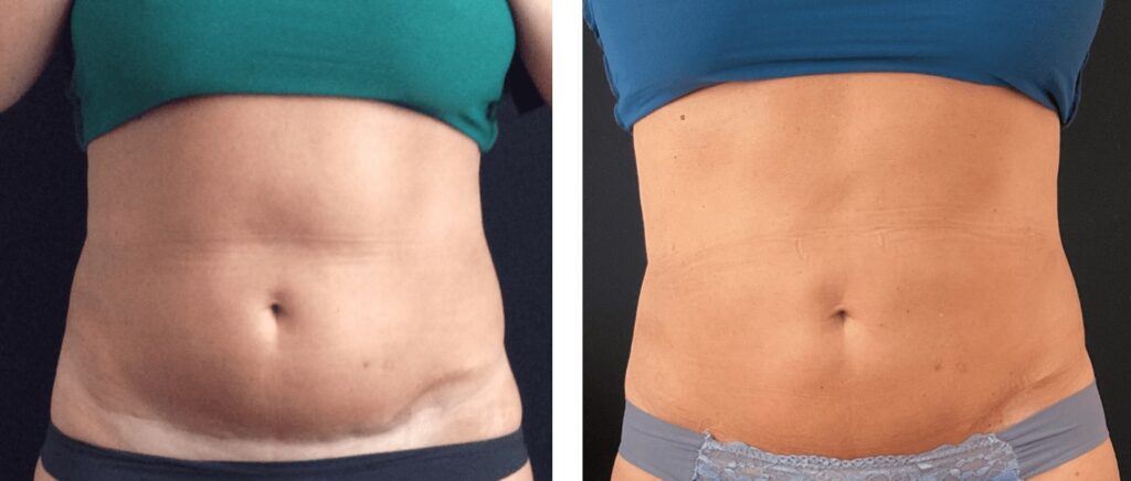 summer ready body contouring, coolsculpting fat freezing before and after