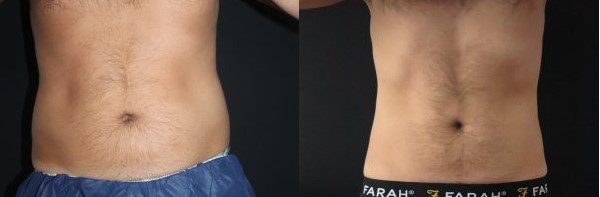 coolsculpting belly fat freezing before and after