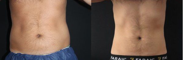 CoolSculpting London - Fat freezing treatments