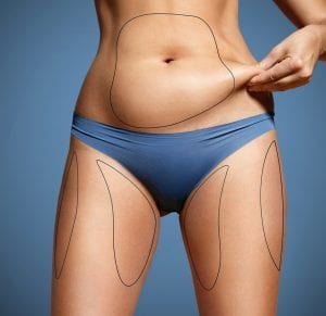 Shape Up for Summer: CoolSculpting, EMSCULPT or Endolift - Which is Right for You?