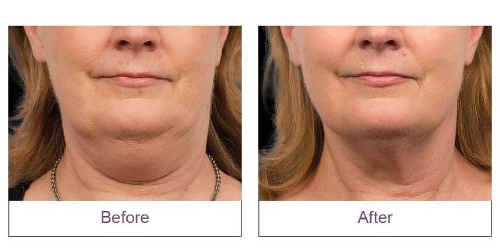 CoolSculpting Event Before and After Double Chin