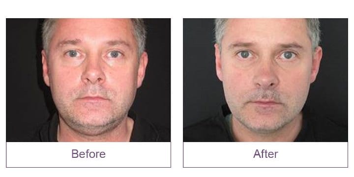 CoolSculpting Event Before and After Face