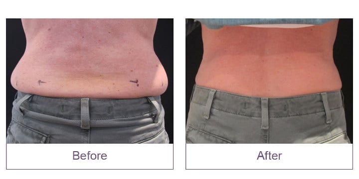 CoolSculpting Event Before and After Love Handles