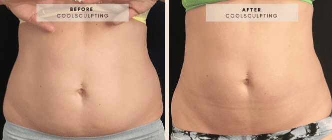 coolsculpting fat freezing before and after - medicated weight loss
