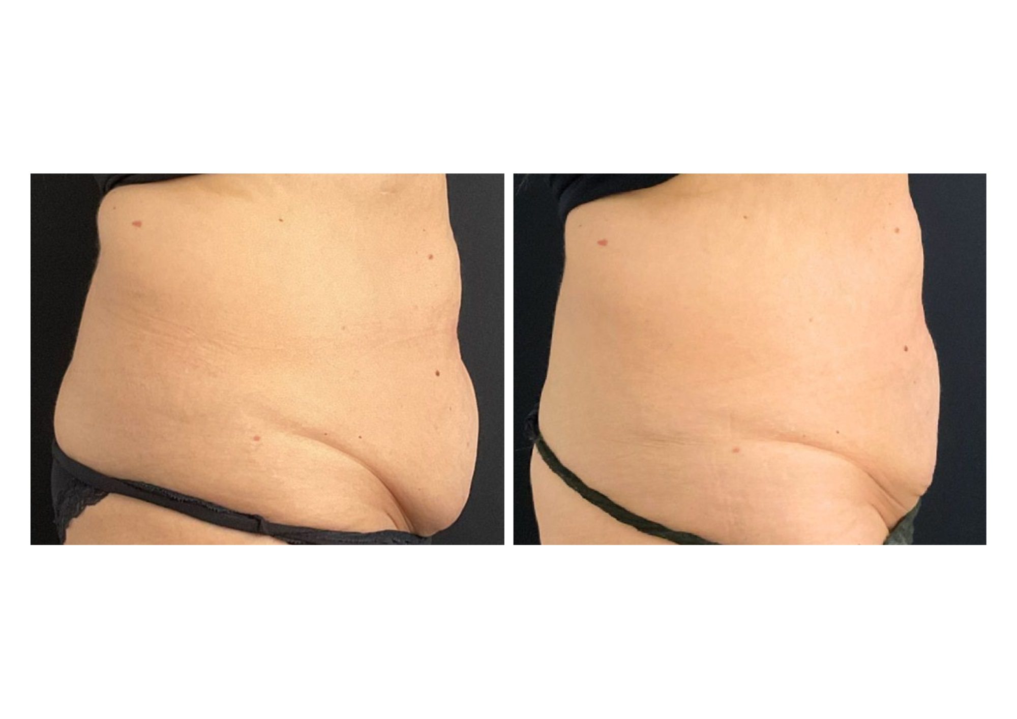 coolsculpting fat freezing belly fat before after results