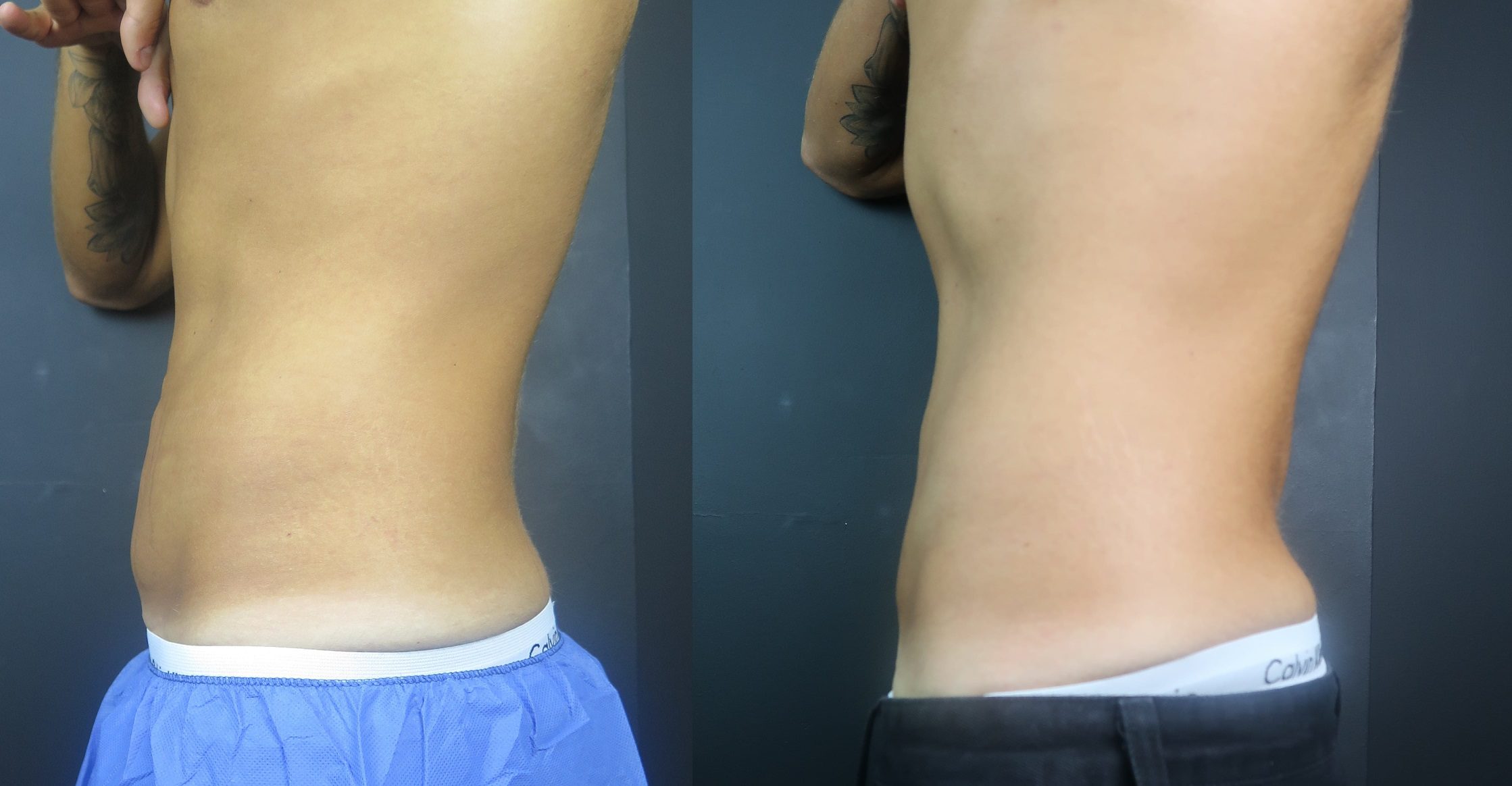 coolsculpting fat freezing belly fat before and after side