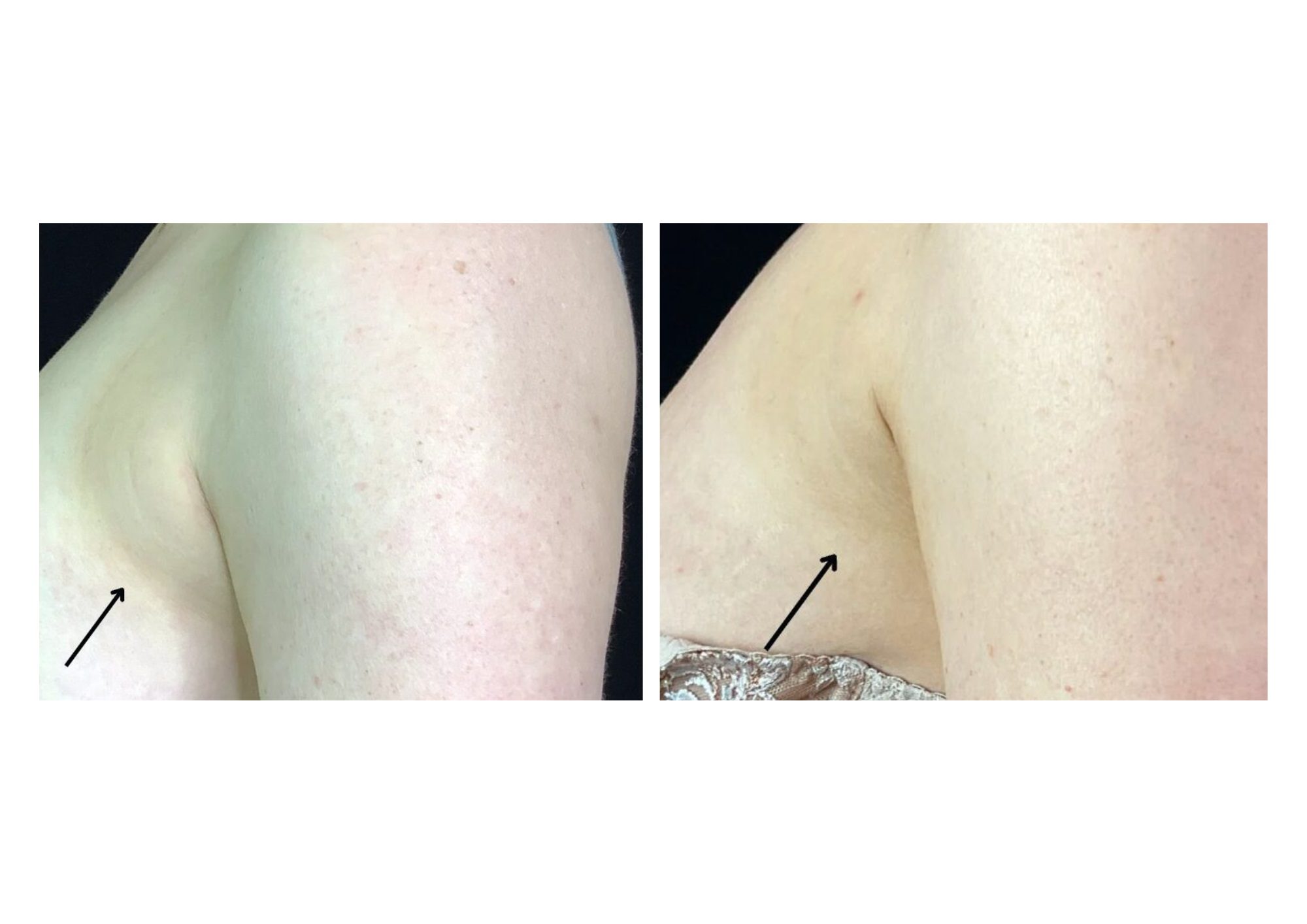 coolsculpting fat freezing bra fat before after results