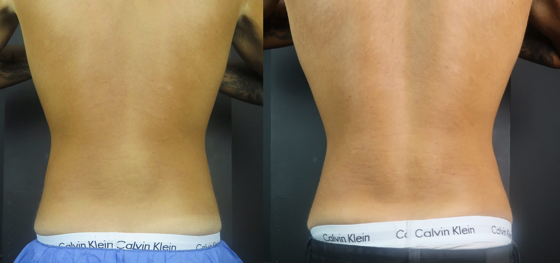 coolsculpting fat freezing flanks before and after