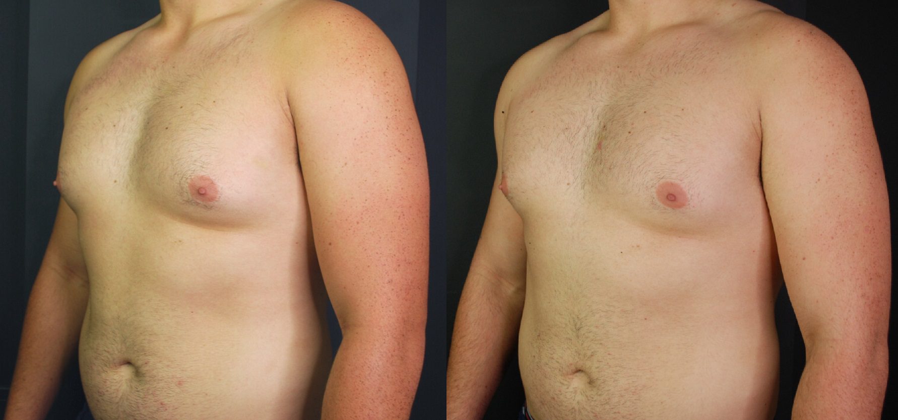 coolsculpting fat freezing male chest reduction before and after