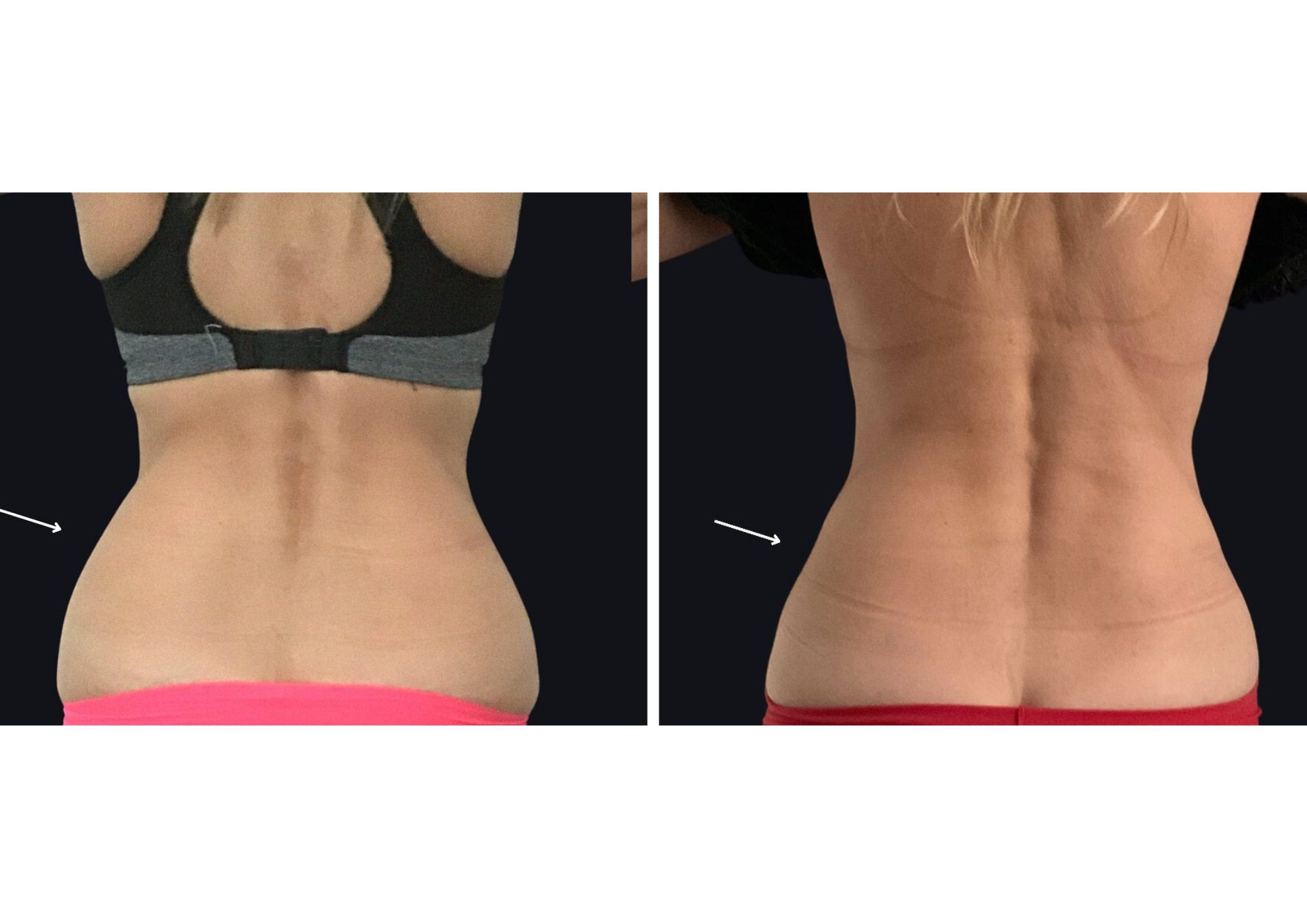 coolsculpting fat freezing muffin tops love handles before after results