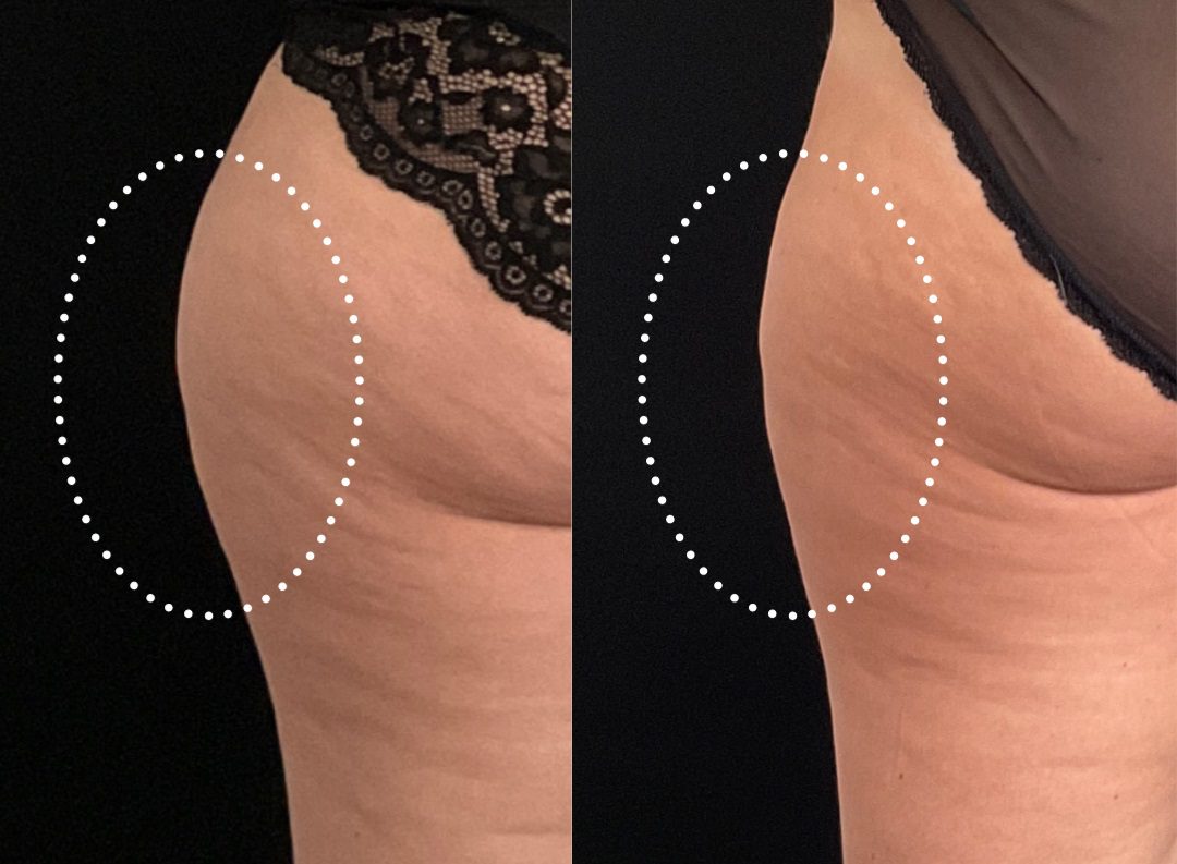 coolsculpting fat freezing outer thigh fat before and after by Ria Murch