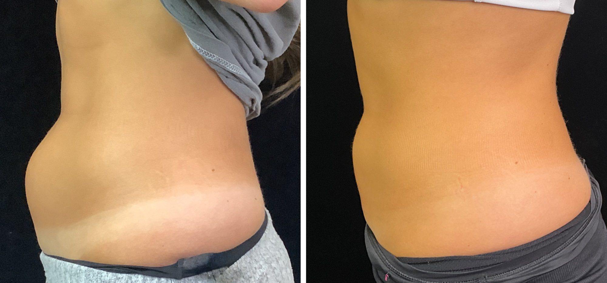coolsculpting fat freezing stubborn fat on tummy before and after