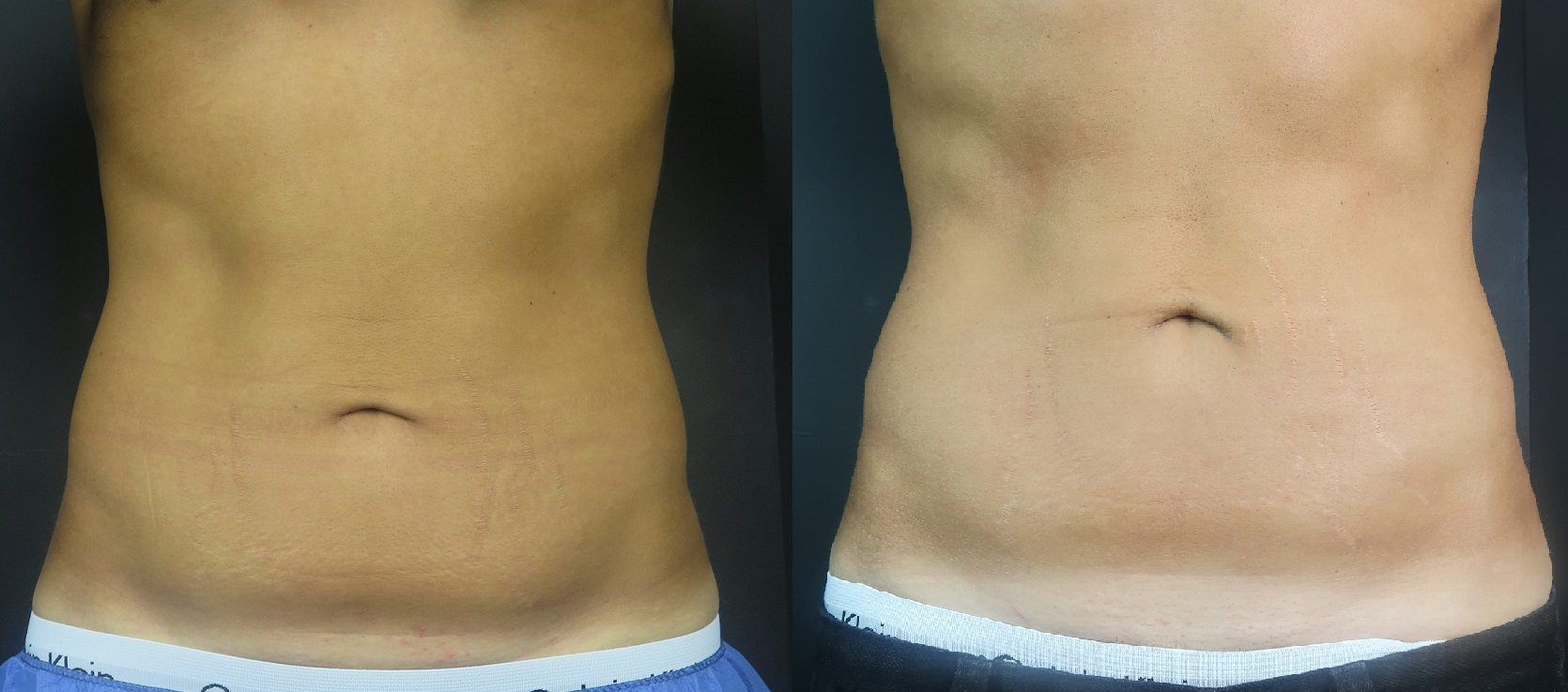 coolsculpting fat freezing stubborn stomach fat before and after