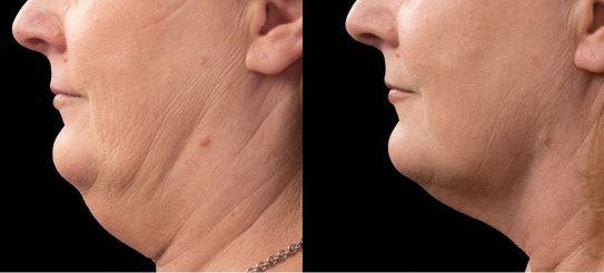 coolsculpting before and after double chin